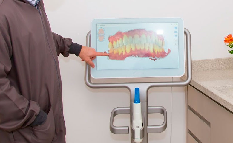 clinica-de-odontologia-estetica-em-atibaia-dentista-scanner-intra-oral